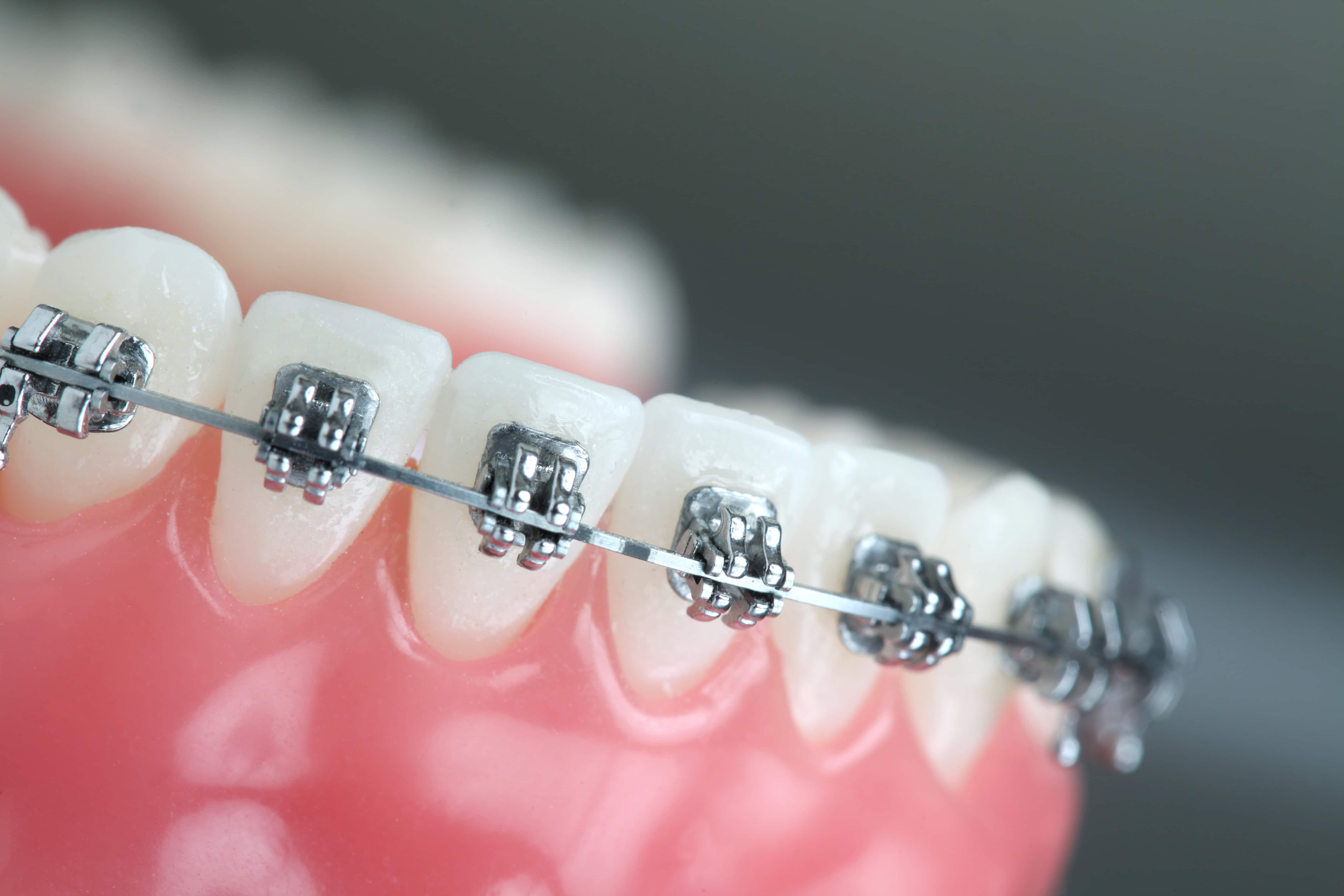 Alternatives to traditional braces for teeth straightening