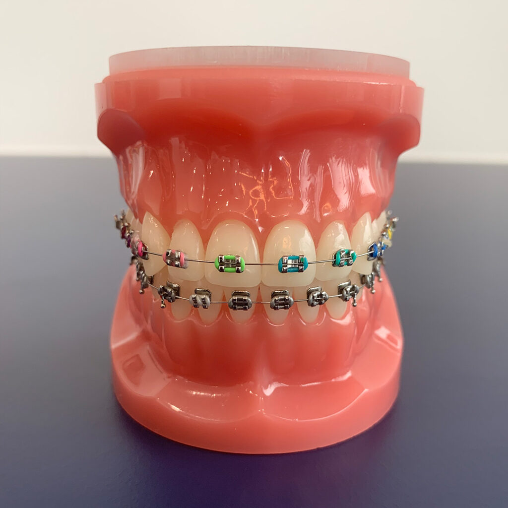 Alternatives To Traditional Braces For Teeth Straightening, Substitutes For Conventional Braces, Nontraditional Dental Aligners, Innovative Teeth Straightening Options, Discreet Orthodontic Alternatives, Teeth Alignment Alternatives, Orthodontic Treatment Alternatives, Nonmetallic Dental Braces, Modern Teeth Straightening Solutions, Novel Dental Aligners, Cuttingedge Orthodontic Options, Advanced Teeth Alignment Methods, Progressive Orthodontic Alternatives, Revolutionary Braces Substitutes, Innovative Dental Aligners, Stateoftheart Teeth Straightening Alternatives, Effective Orthodontic Substitutes, Unconventional Braces Options, Innovative Dental Treatment Choices, Discreet Teeth Straightening Methods, Advanced Orthodontic Solutions, Custom Dental Aligners, Orthodontic Innovations, New Teeth Alignment Techniques